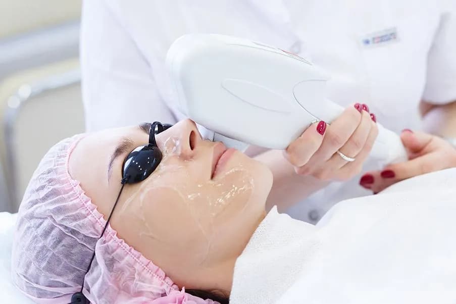 BBL / IPL Photofacial